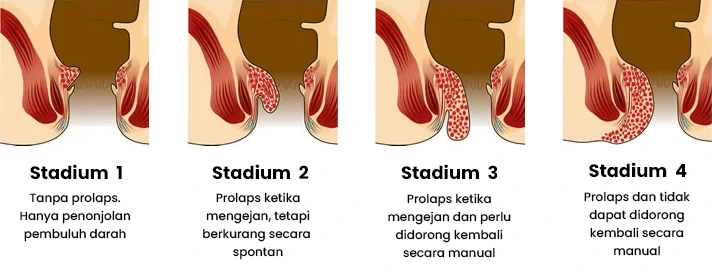 Stadium wasir